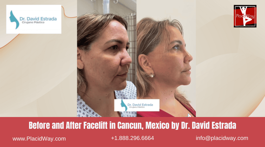 Facelift In Cancun, Mexico Dr. David Estrada