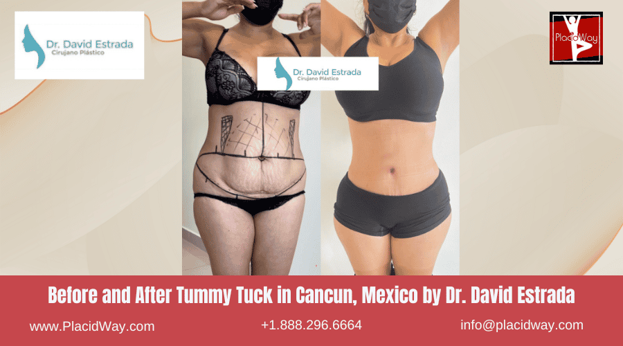 Tummy Tuck In Cancun, Mexico Dr. David Estrada