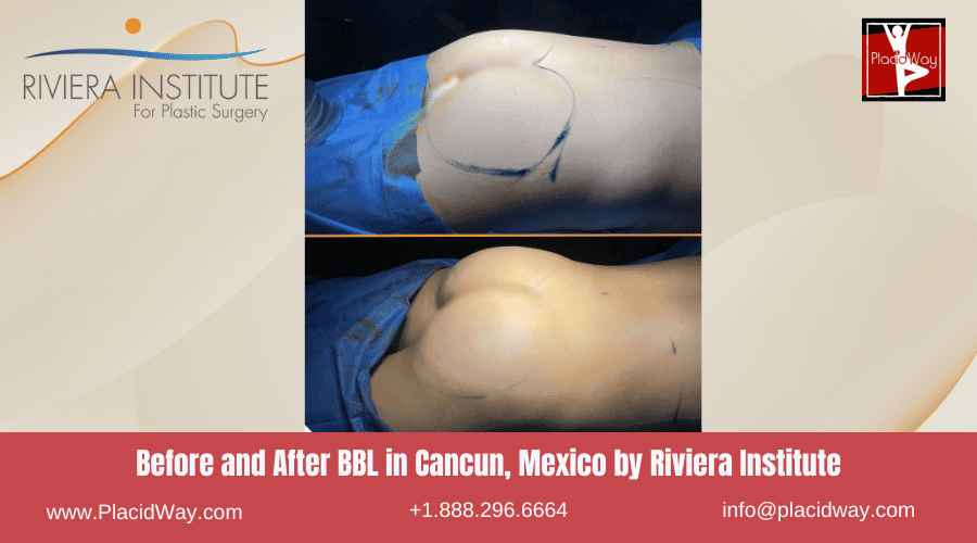 BBL in Cancun, Mexico by Riviera Institute Before After Images