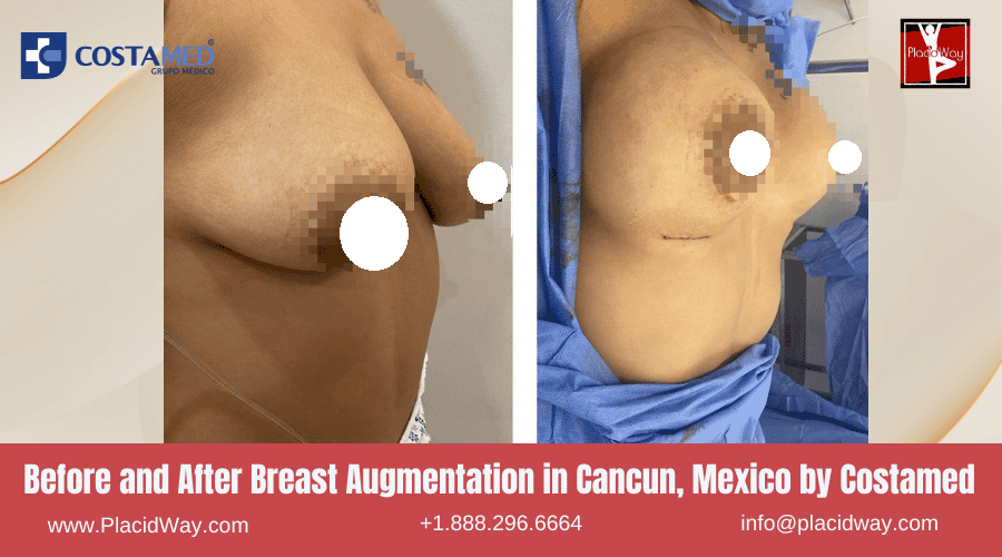 Breast Augmentation In Cancun, Mexico By Costamed