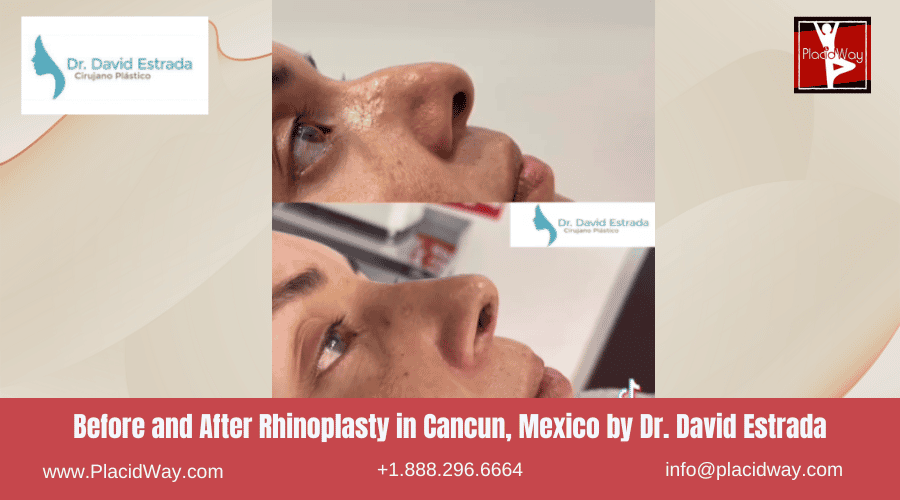 Rhinoplasty In Cancun, Mexico Dr. David Estrada