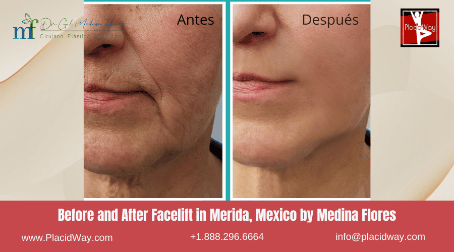 Facelift In Merida, Mexico By Medina Flores