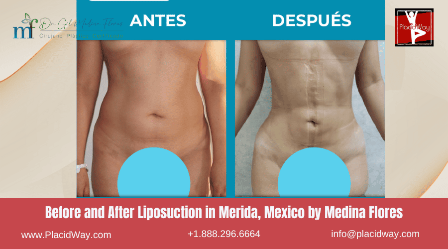Liposuction In Merida, Mexico By Medina Flores