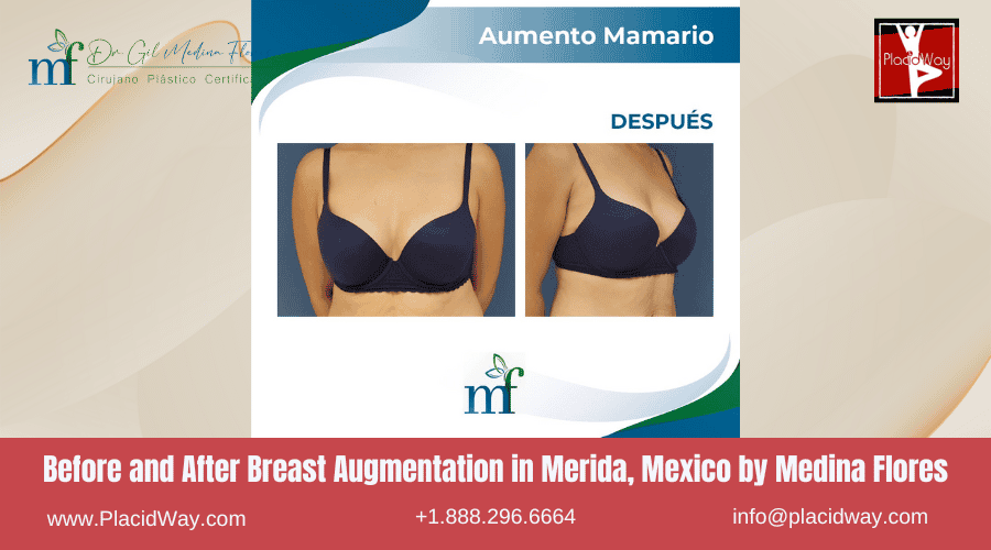 Breast Augmentation In Merida, Mexico By Medina Flores