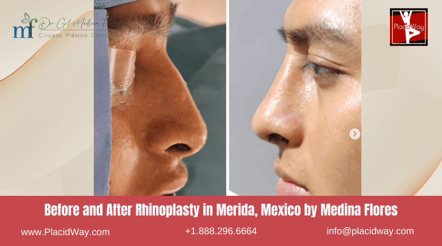 Rhinoplasty In Merida, Mexico By Medina Flores