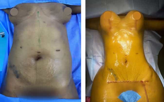 Abdominoplastia Antes Después El Vergel