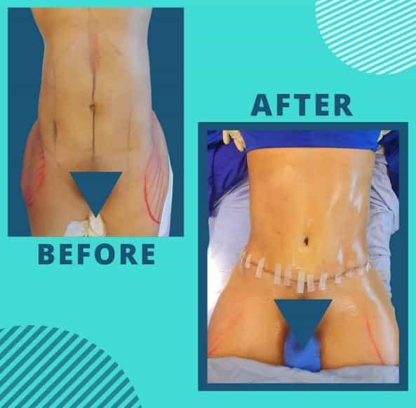 Imagen Antes y Después de Abdominoplastia en República Dominicana de Javier Baez