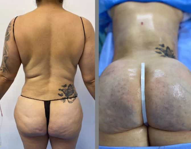 IMAGEN ANTES Y DESPUÉS DE BBL EL VERGEL