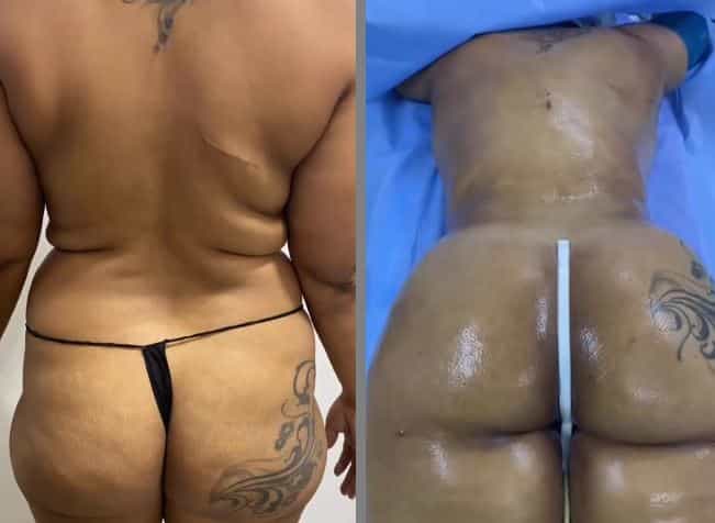 IMAGEN ANTES Y DESPUÉS DE LA CLÍNICA BBL EL VERGEL