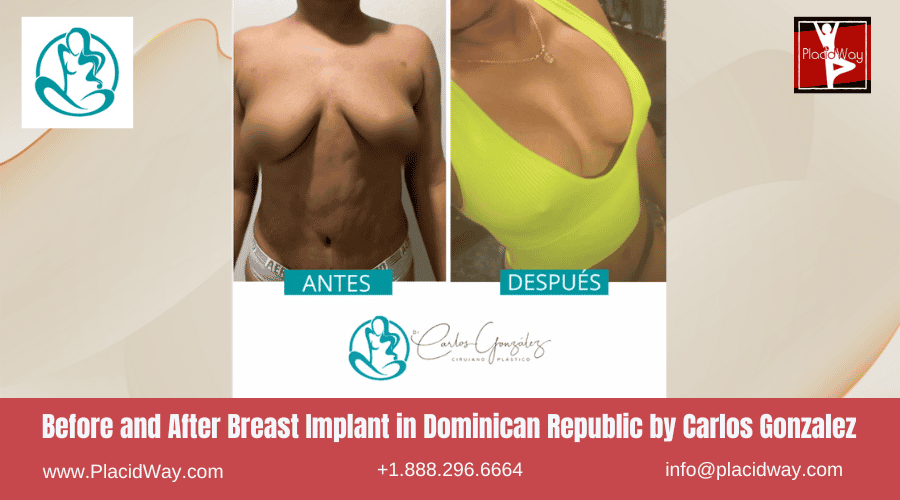 Breast Augmentation In Dominican Republic By Carlos Gonzalez