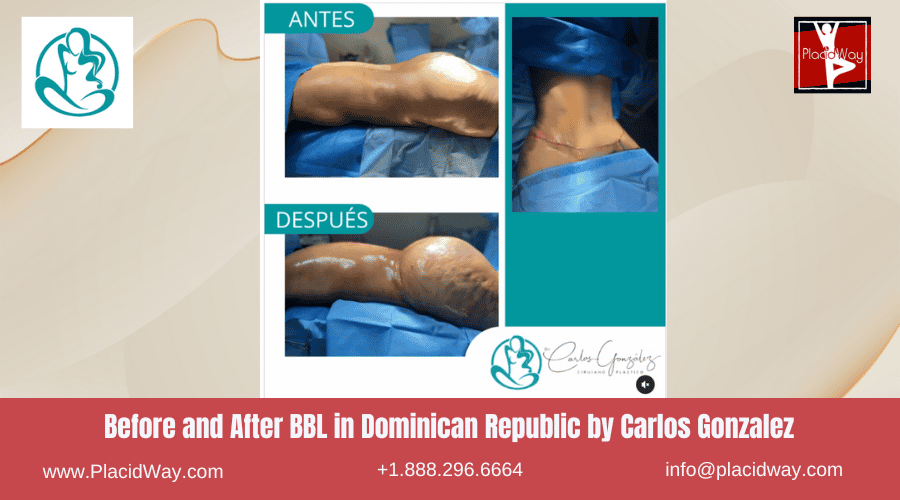 Bbl In Dominican Republic By Carlos Gonzalez