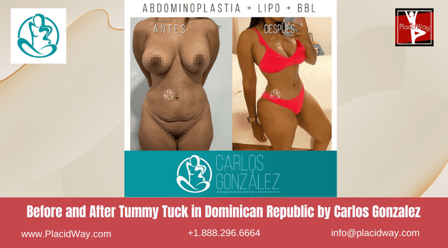 Tummy Tuck In Dominican Republic By Carlos Gonzalez