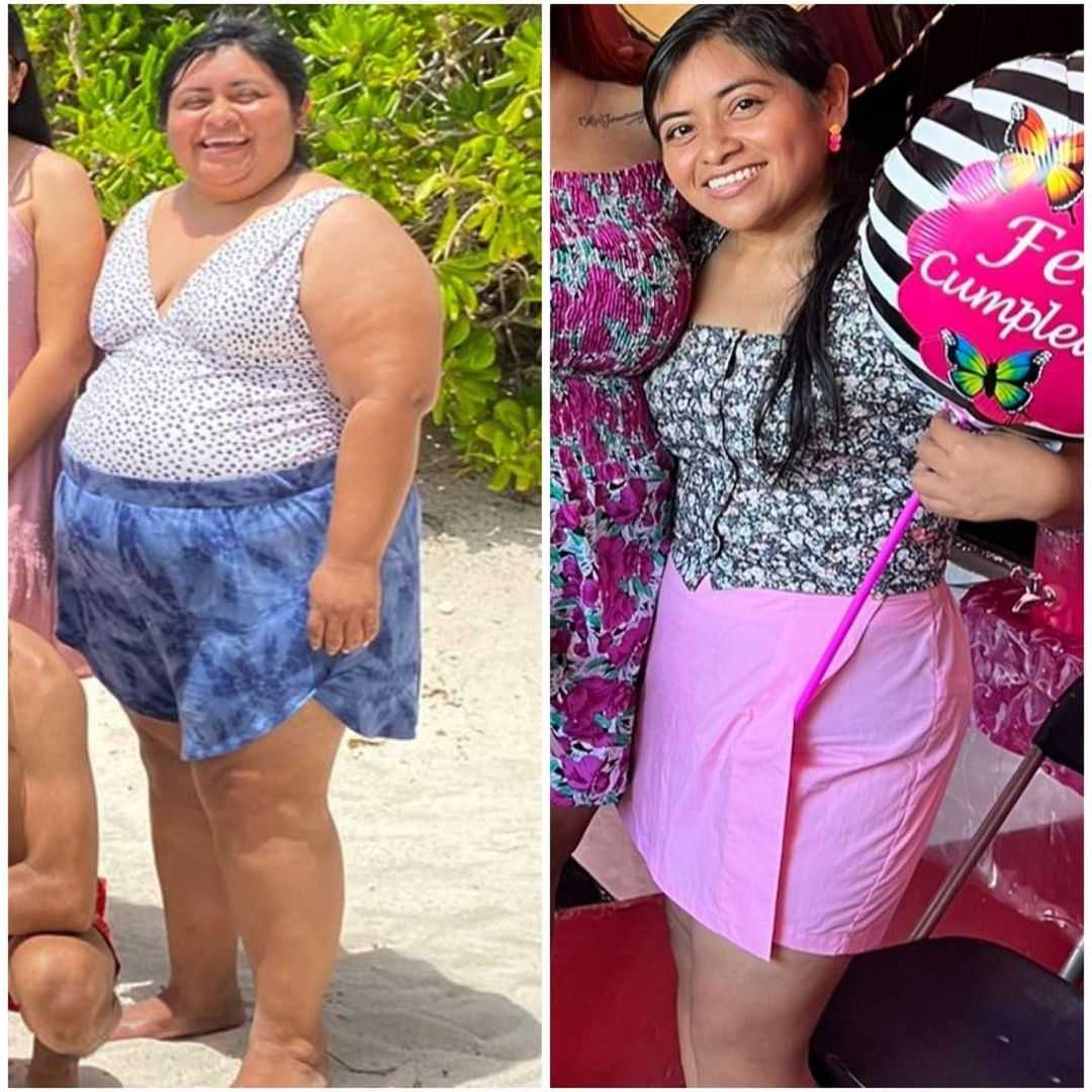 Antes y después del paquete Mini Bypass Gástrico de Salud Metabólica en Cancún, México