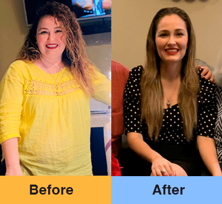 Cirugía de Banda Gástrica en Piedas Negras, México Imagen de Antes y Después