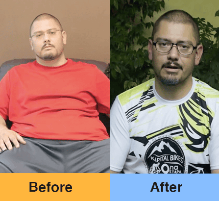 Banda Gástrica en Piedas Negras, México Imagen Antes y Después