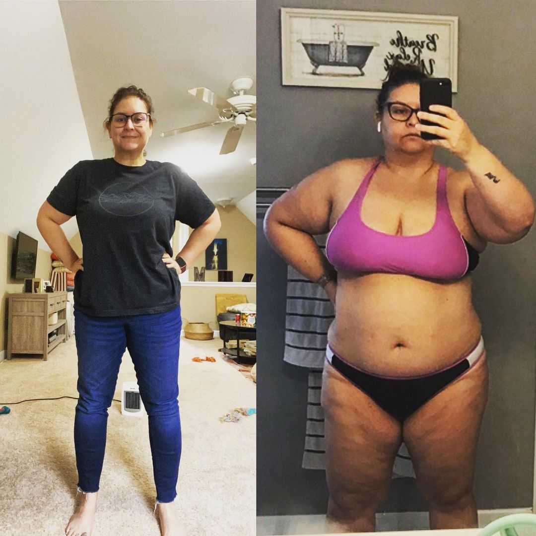 Paquete de Bypass Gástrico de Metabolic Health en Cancún, México Antes y Después