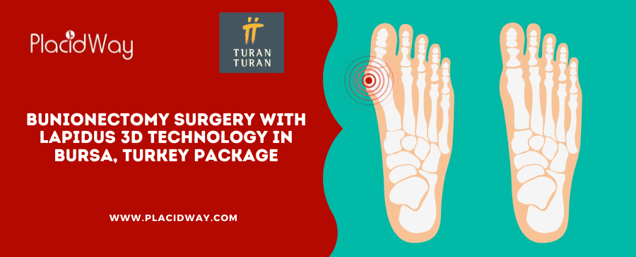 Paquete de cirugía de bunionectomía con tecnología 3D LAPIDUS en Bursa, Turquía Bunionectomy Surgery with LAPIDUS 3D Technology in Bursa, Turkey Package