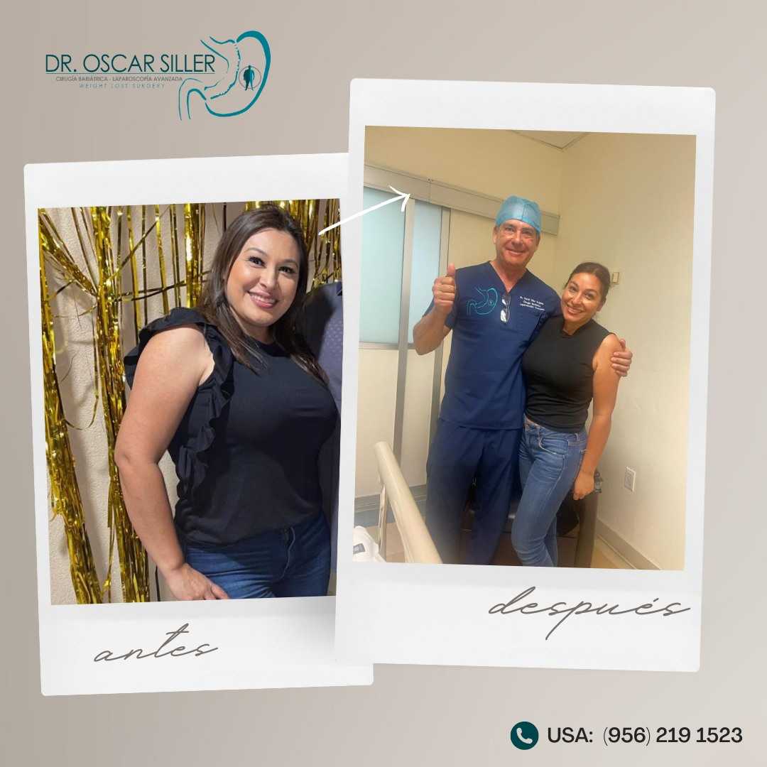 Imagen Antes y Después de Manga Gástrica en Reynosa México