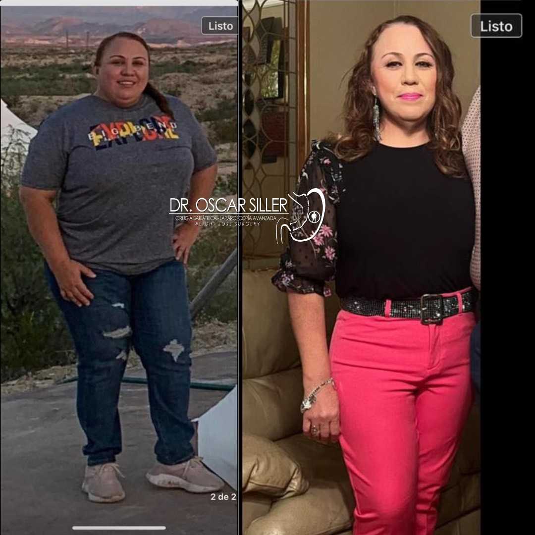 Imagen Antes y Después de Manga Gástrica de Oscar Siller en Reynosa México