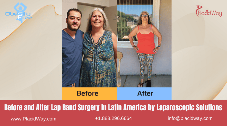 Lap Band Surgery in Latin America Before and After Images - Laparoscopic Solutions