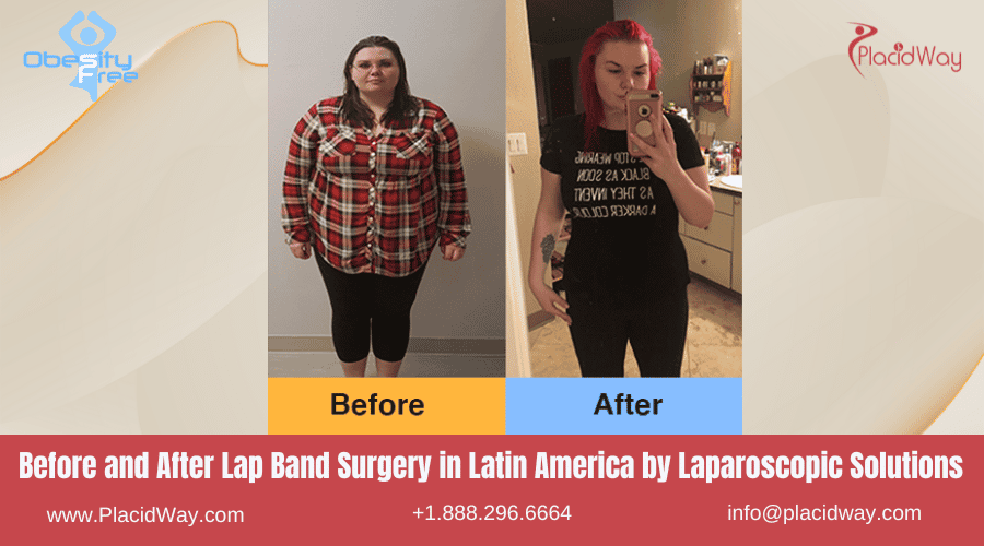 Lap Band Surgery in Latin America Before and After Images - Laparoscopic Solutions Clinic