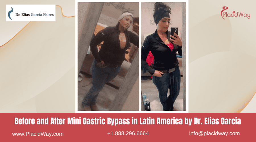 Mini Gastric Bypass in Latin America Before and After Images - Dr Elias Garcia