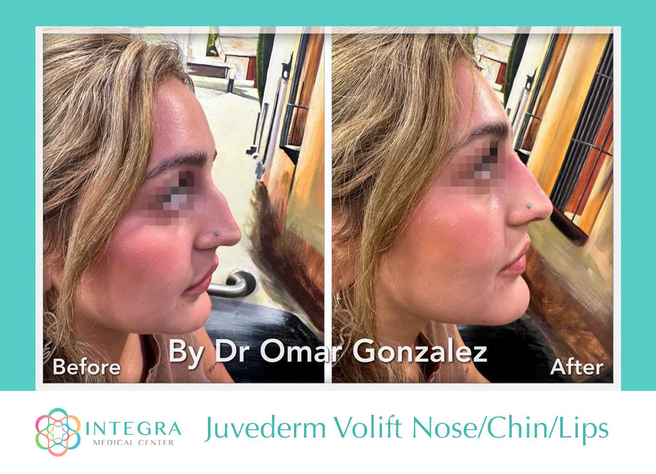 Antes y después de la aplicación de Juvederm Volift en nariz, mentón y labios por el Dr. Omar González en el Centro Médico Integra en Nuevo Progreso, México