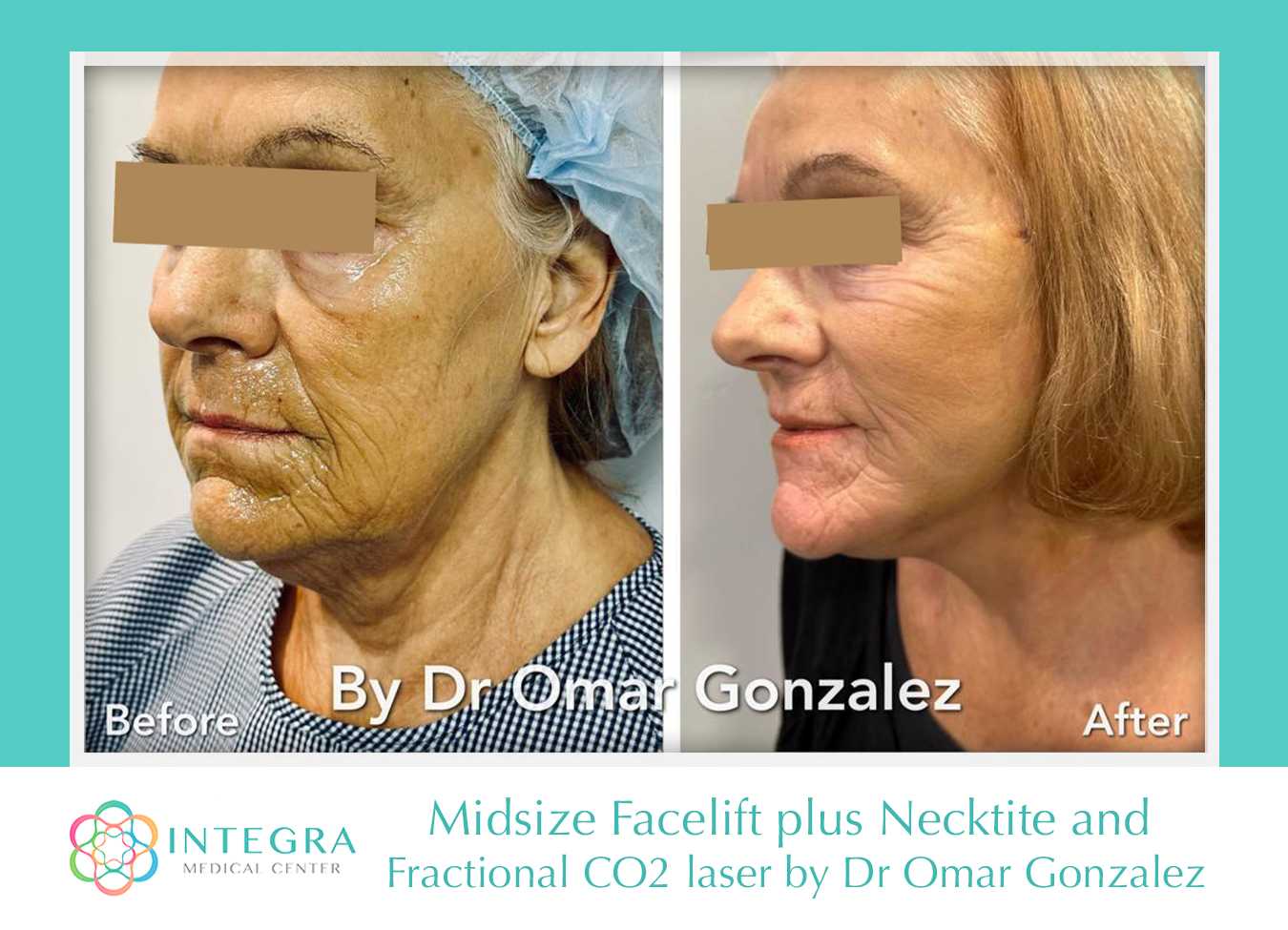 Antes y después: lifting facial de tamaño mediano más lifting de cuello y láser de CO2 fraccionado. Por el Dr. Omar González en Integra Medical Center en Nuevo Progreso, México