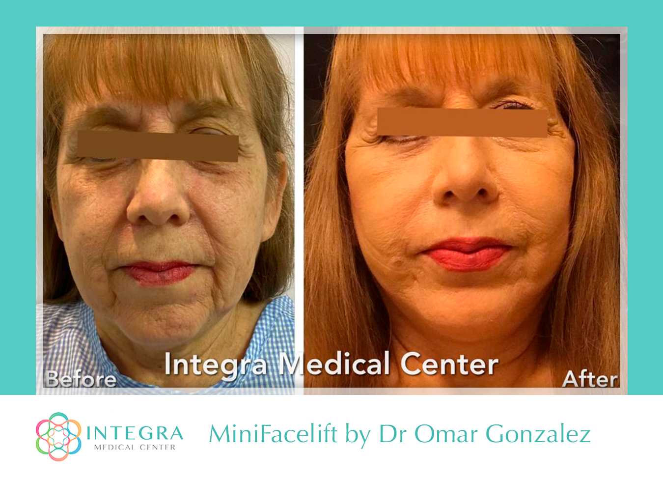 Antes y después del procedimiento MiniFaceLift en Integra Medical Center