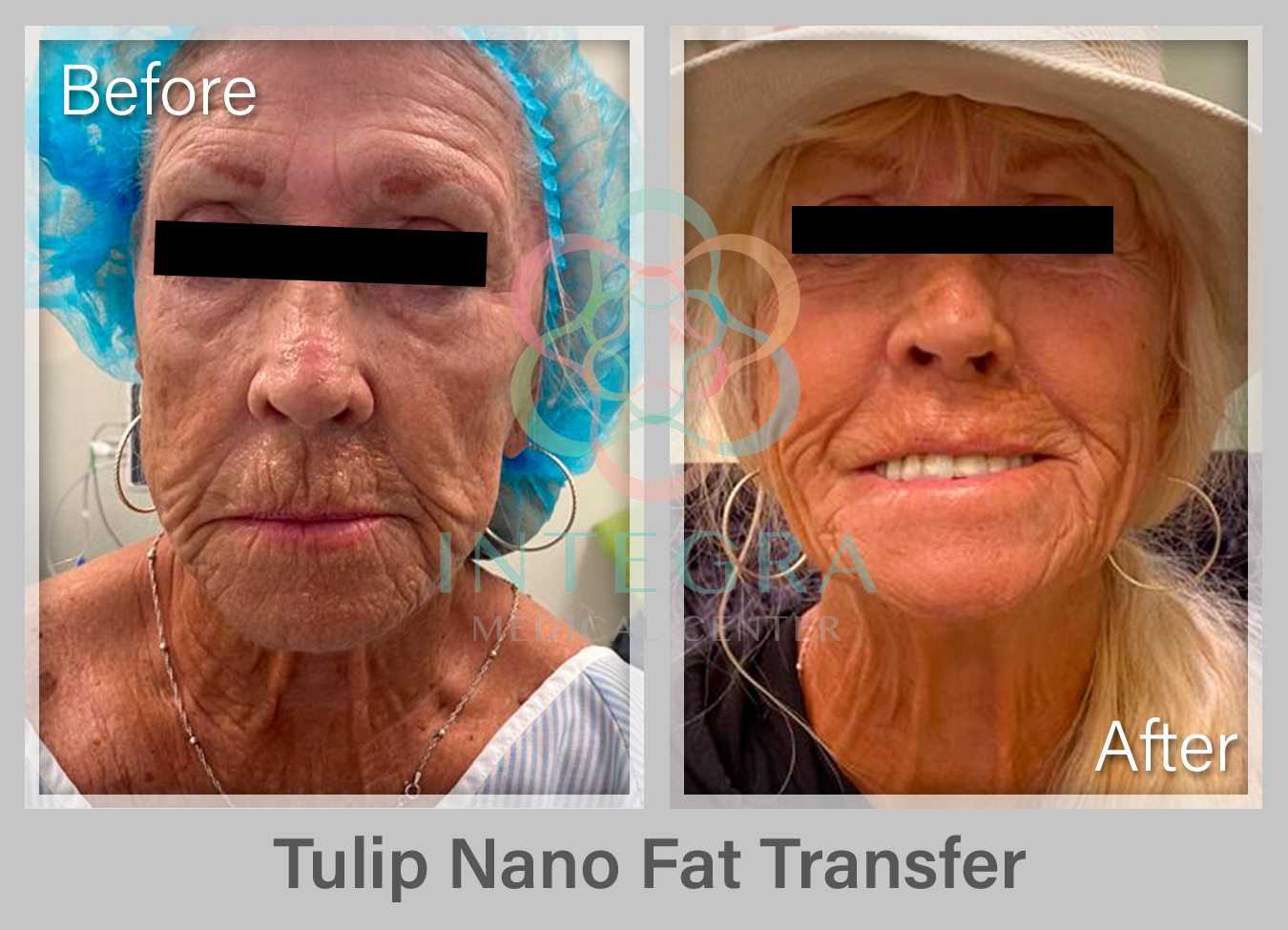 Antes y después: transferencia de grasa con Tulip Nano