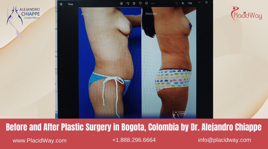 Avant et après une intervention de chirurgie esthétique à Bogota, en Colombie, par le Dr Alejandro Chiappe