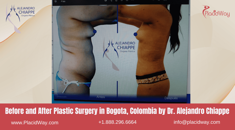Chirurgie esthétique avant-après à Bogota, Colombie, par le Dr Alejandro Chiappe