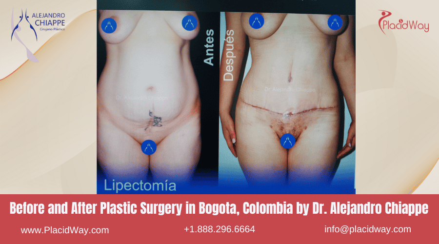 Avant et après la chirurgie esthétique à Bogota, Colombie