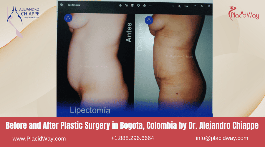 Alejandro Chiappe avant et après une chirurgie esthétique à Bogota, Colombie