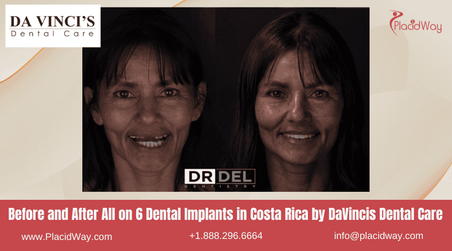 All On  Dental Implants In Costa Rica By Davincis Dental Care   Before And After