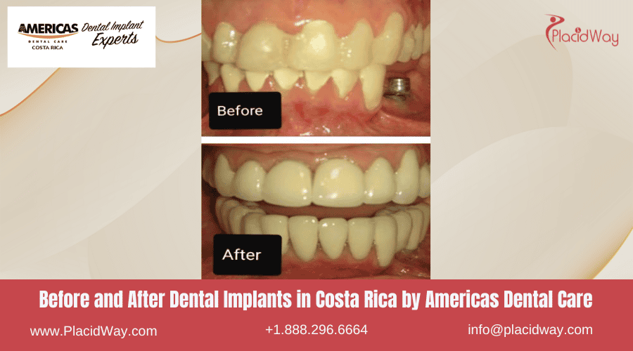 Dental Implants In Costa Rica By Americas Dental Care   Before And After