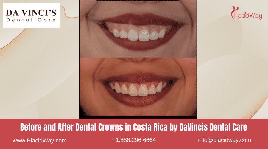 Dental Crowns In Costa Rica By Davincis Dental Care   Before And After