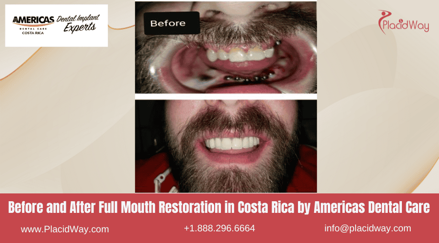 Restauración de boca completa en Costa Rica por Americas Dental Care - Antes y después