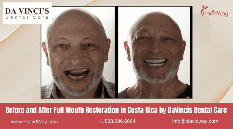 Restauración de boca completa en Costa Rica por DaVincis Dental Care: imágenes de antes y después