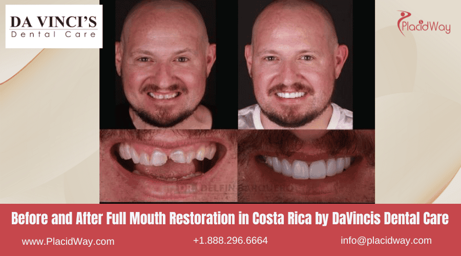 Restauración de boca completa en Costa Rica por la Clínica DaVincis - Antes y después