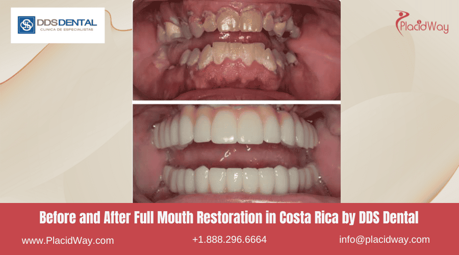 Restauración de boca completa en Costa Rica por DDS Dental Clinic - Antes y después