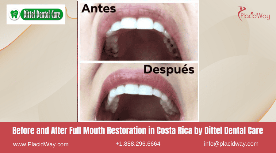 Restauración de boca completa en Costa Rica por Dittel Dental Care: antes y después