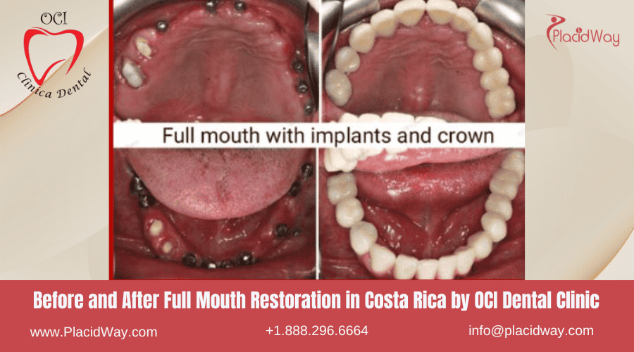 Restauración de boca completa en Costa Rica por OCI Dental - Antes y después