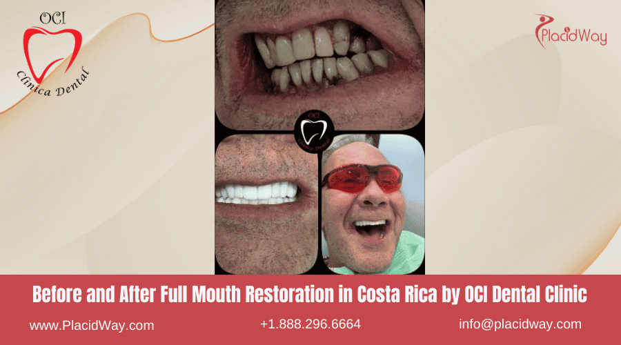 Restauración de Boca Completa en Costa Rica por Clínica Dental OCI Liberia - Antes y Después