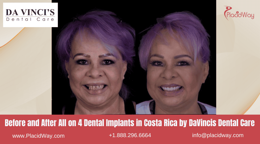 All On  Dental Implants In Costa Rica By Davincis Dental Care   Before And After