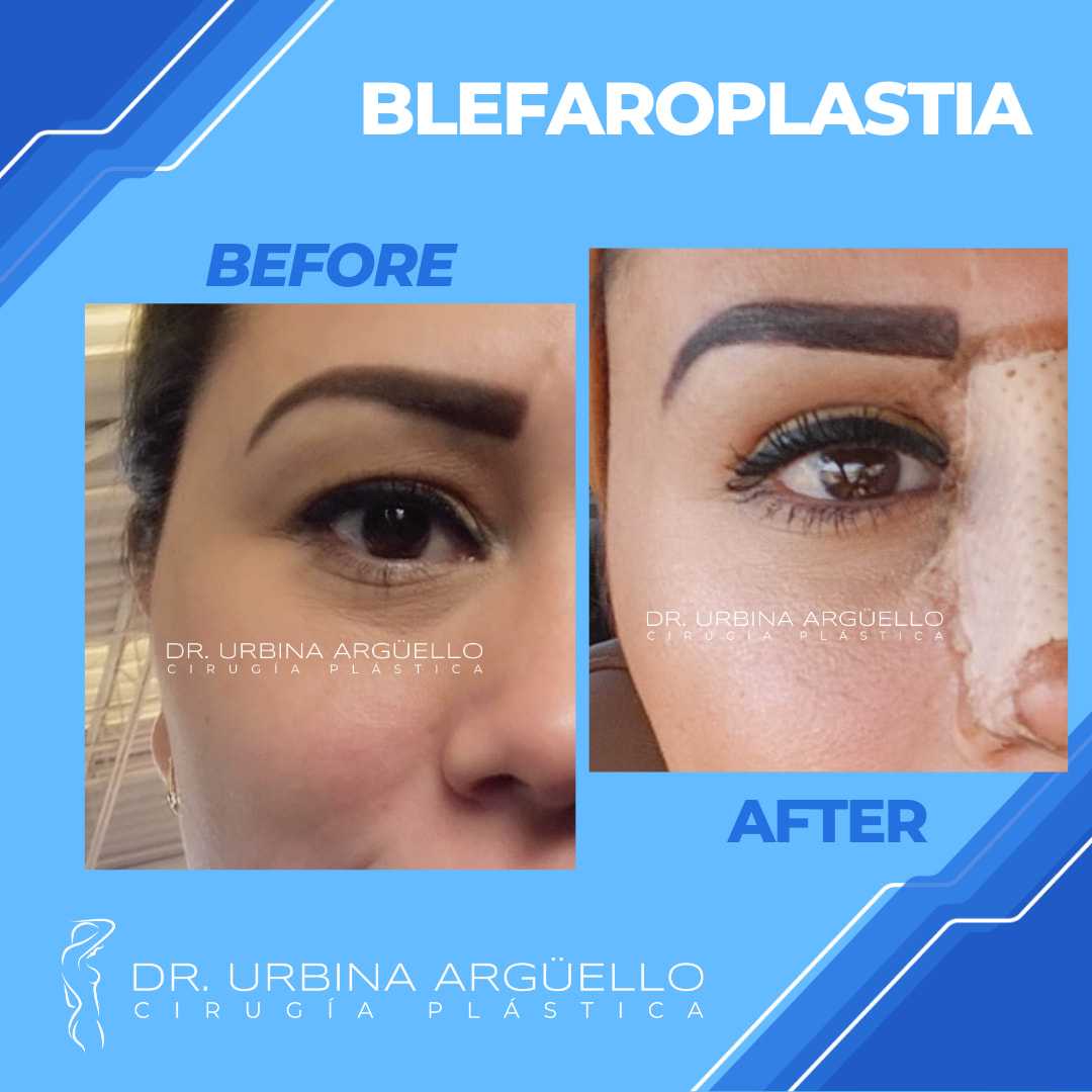 Antes y después de la blefaroplastia en Matamoros, México