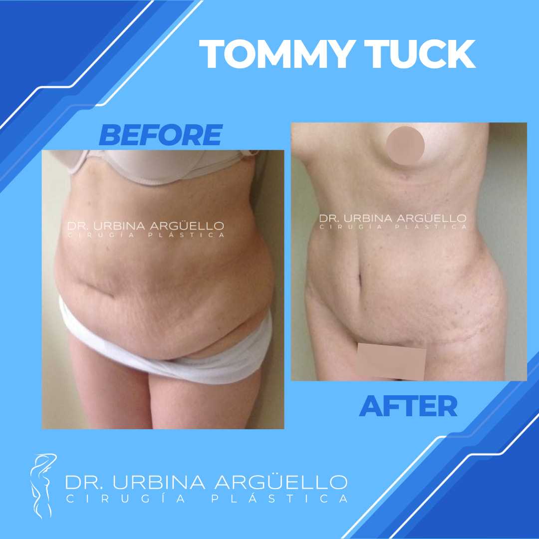 Antes y después de una rinoplastia en Matamoros, México