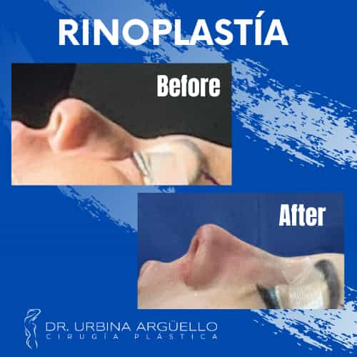 Antes y después de una abdominoplastia en Matamoros, México