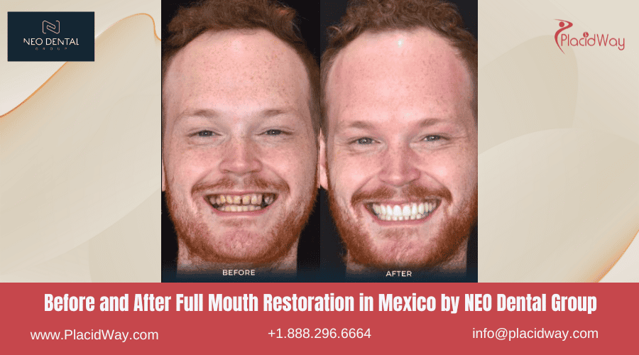 Full Mouth Restoration in Mexico Before and After Image by NEO Dental Clinic