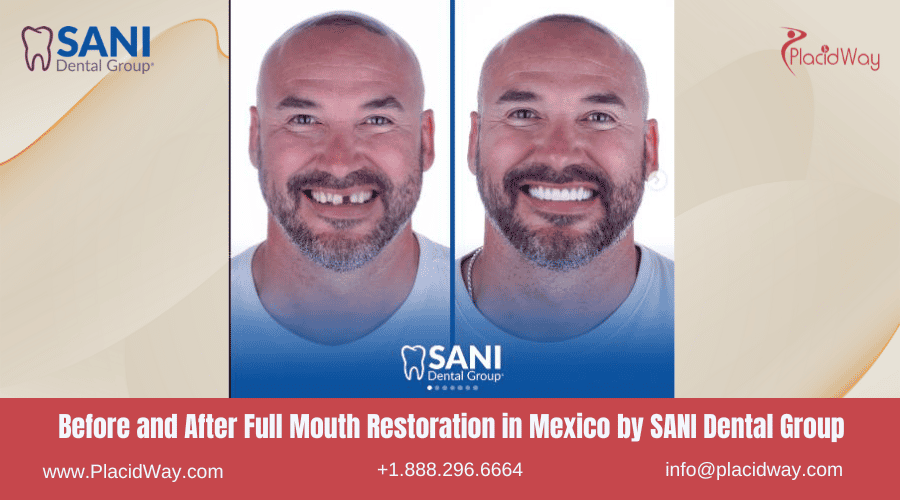 Full Mouth Restoration in Mexico Before and After Image by SANI Dental